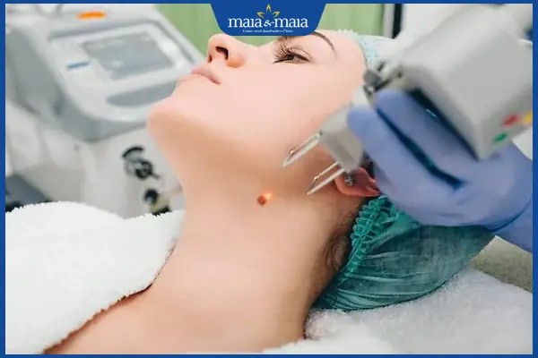 Sử dụng công nghệ laser để tẩy nốt ruồi an toàn.